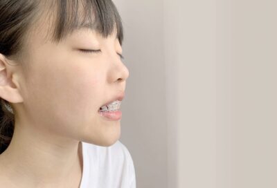 ワイヤー矯正各種と比較のアイキャッチ画像