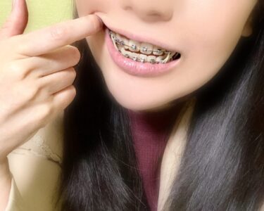 ワイヤー矯正の支払いについてのアイキャッチ画像